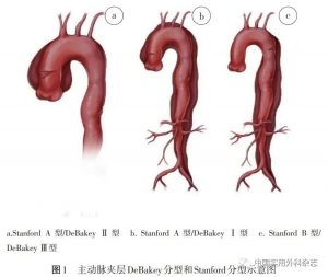 主动脉夹层分型